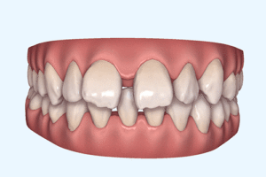 空隙歯列（すきっ歯）の症例1