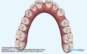 空隙歯列（すきっ歯）の症例2