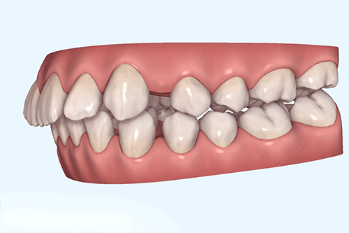 空隙歯列（すきっ歯）の症例3
