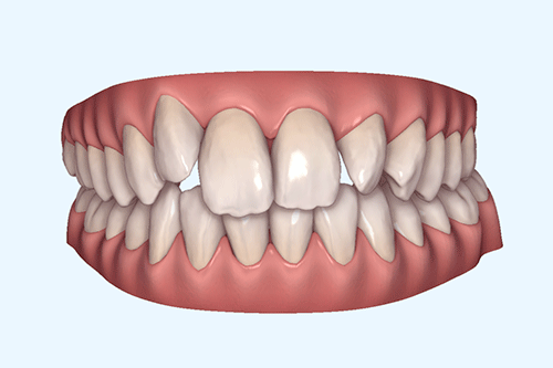 狭窄歯列の症例1