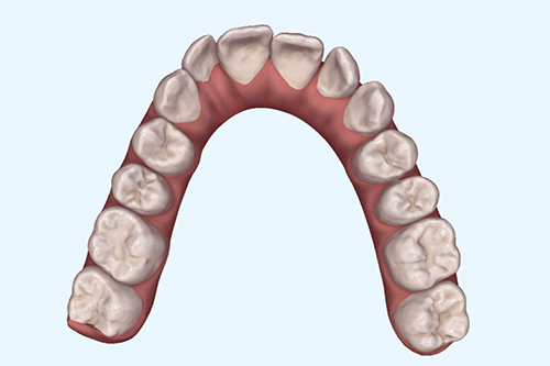 狭窄歯列の症例2