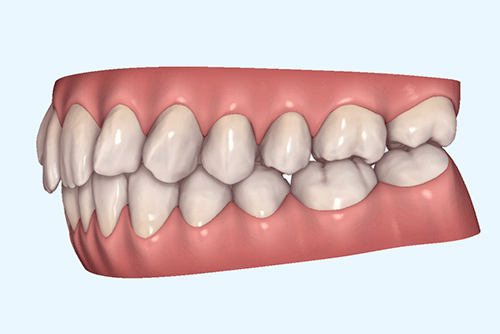 狭窄歯列の症例3