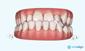 インビザラインの治療計画