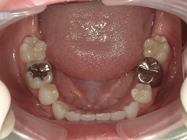 症例1 治療後3