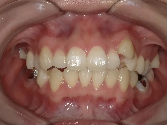 症例1 治療前1