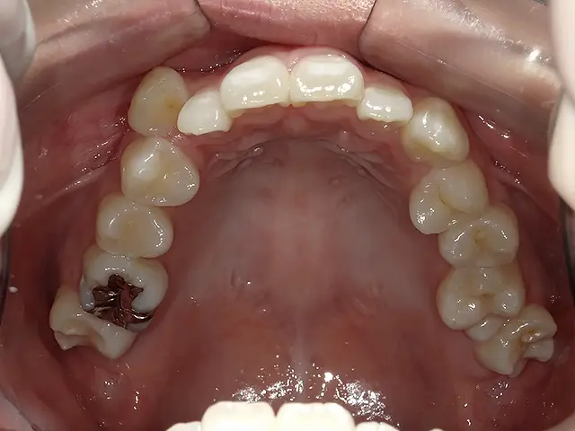 症例1 治療前2