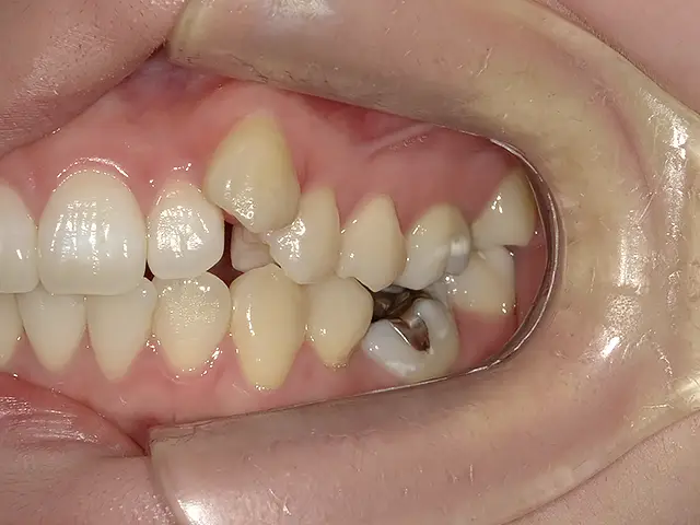 症例1 治療前4